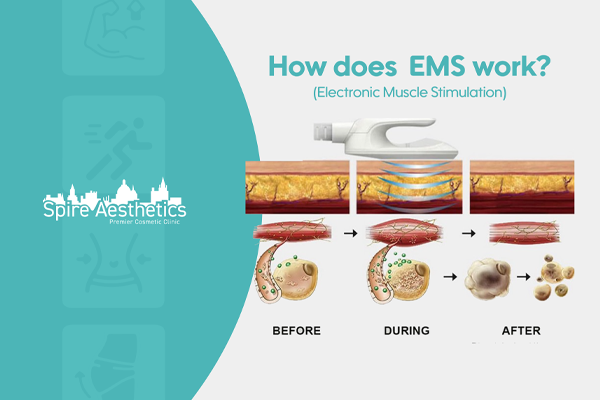 EMS treatment for post pregnancy weight loss treatment Thames Ditton