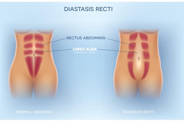 What Non-Surgical Options Are Available for Diastasis Recti Thames Ditton?