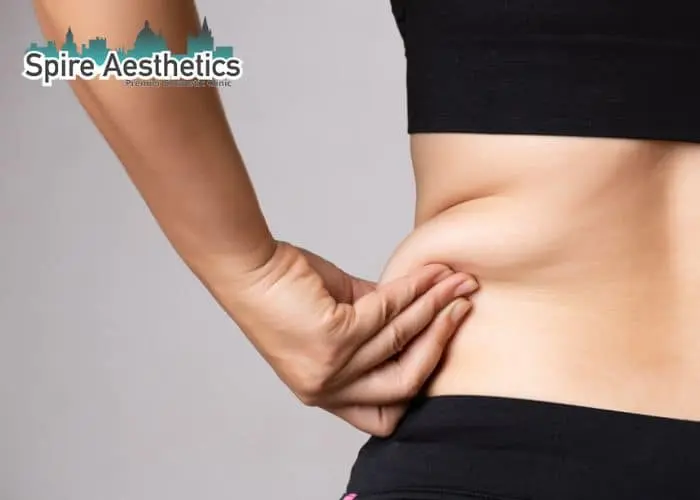 Image of woman pinching fat on their hips Thames Ditton. Fat Freezing treatment