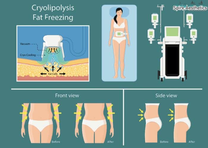 Image of diet and fat freezing combined for best results for Spire Aesthetics Thames Ditton