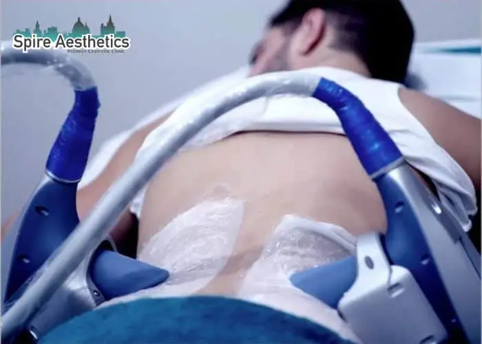 Man having fat freezing treatment done on love handles before a competitions Thames Ditton to create a sculpted look.