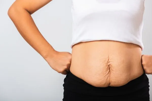 Image of a woman's stomach after weight loss with sagging skin following a gastric band Thames Ditton
