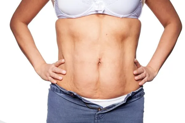 sagging skin on woman's stomach after weight loss injections Thames Ditton