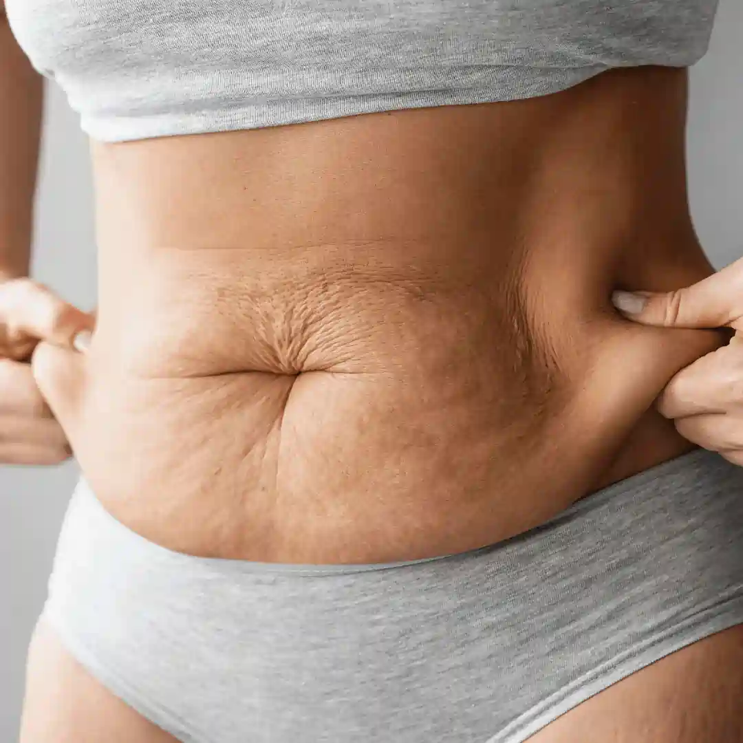 Is It Normal to Have Loose Skin After Pregnancy Thames Ditton?