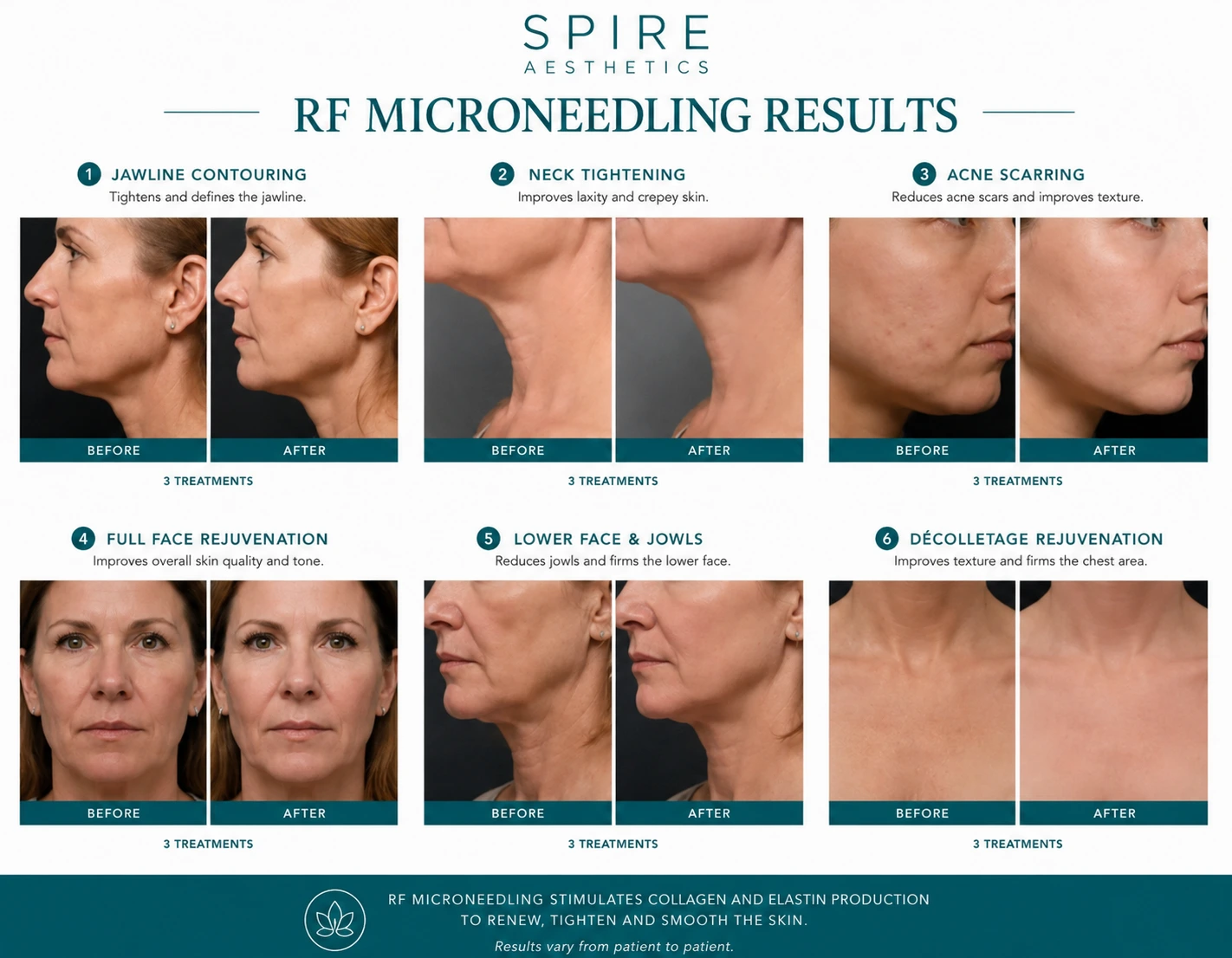 RF Microneedling Skin tightening Thames Ditton results