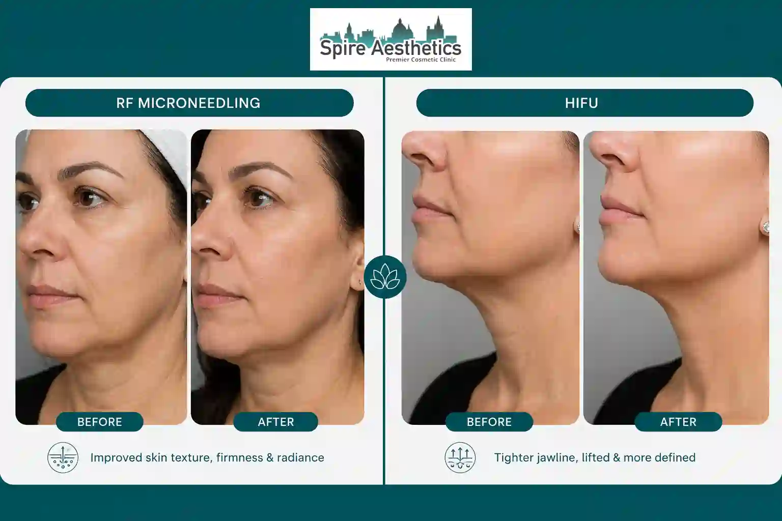 Can RF Microneedling and HIFU Be Combined Thames Ditton?
