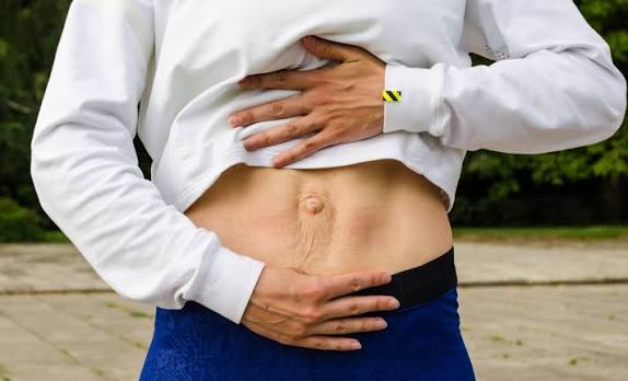 When Could Diastasis Recti Be the Missing Piece of the Puzzle Thames Ditton?