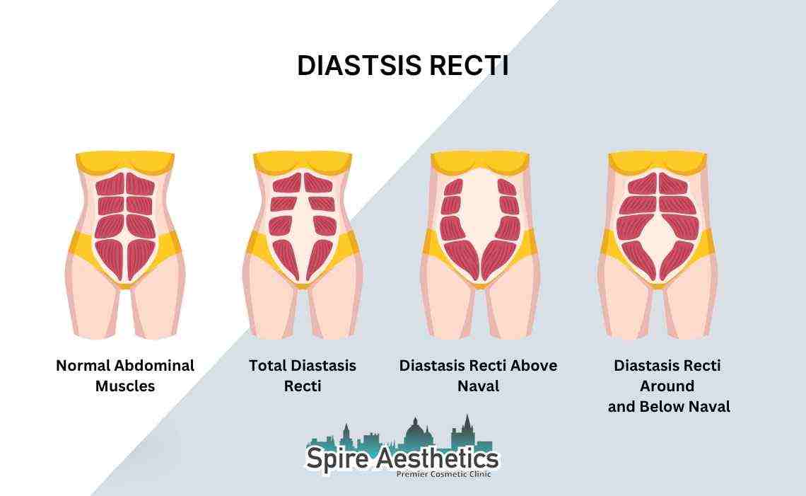 Is Non-Surgical Diastasis Recti Treatment Right for You? Common Concerns Answered Thames Ditton